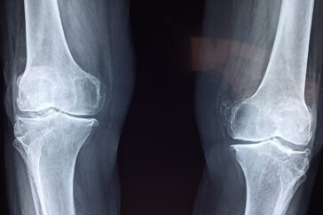 knee, x-ray, medical